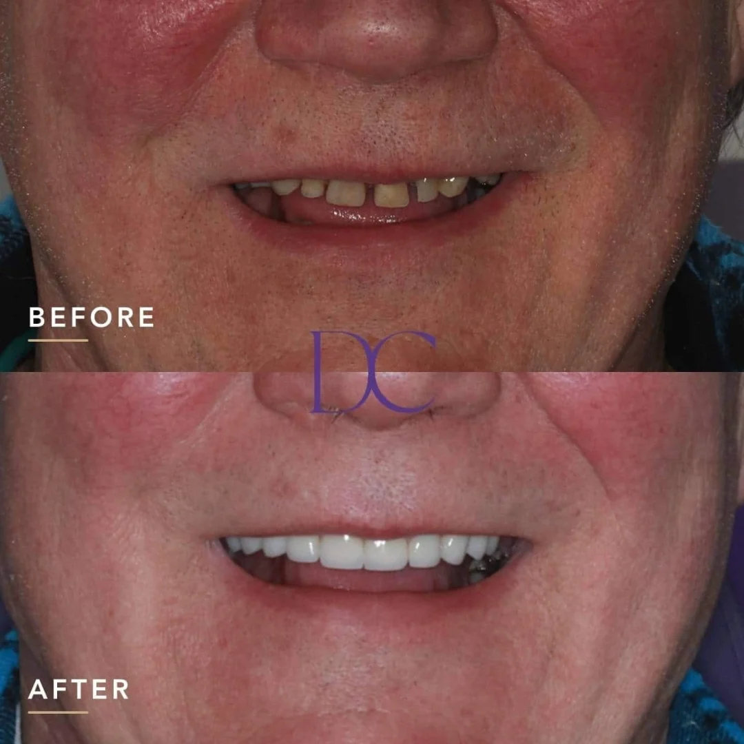 Mr. J.L.'s Dental Implants and Dental Crowns Journey in Melbourne North West At Dental Couture