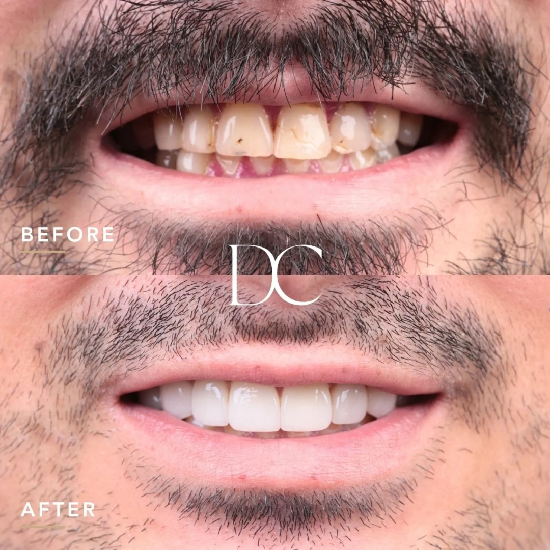 Nathan of Sunbury's Porcelain Veneers Journey at Dental Couture