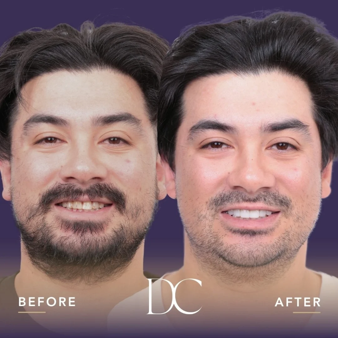 Nathan of Sunbury's Porcelain Veneers Journey in Dental Couture