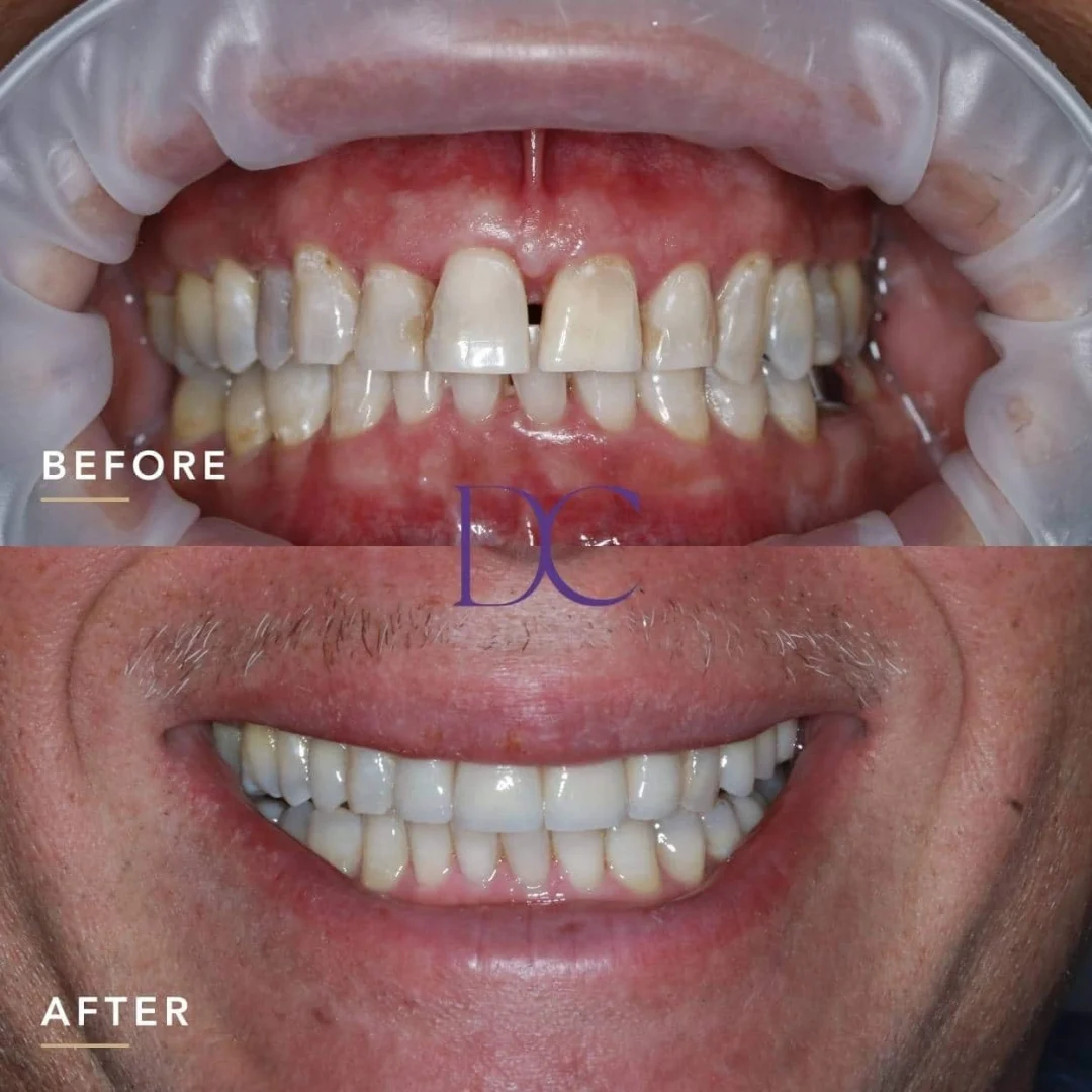 Oscar's Porcelain Veneers, Dental Crowns, and Whitening Journey in Melbourne North West At Dental Couture
