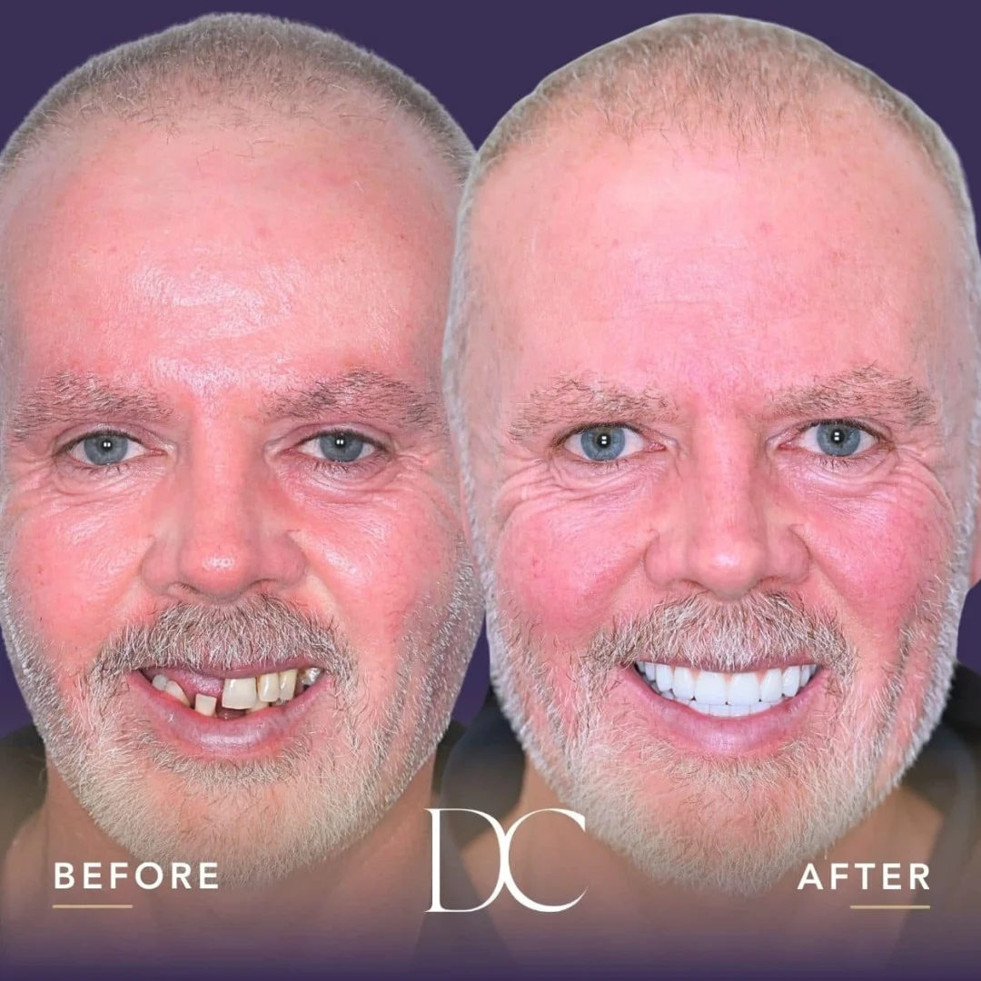 Peter of Melbourne's A04 Smile Journey in Dental Couture