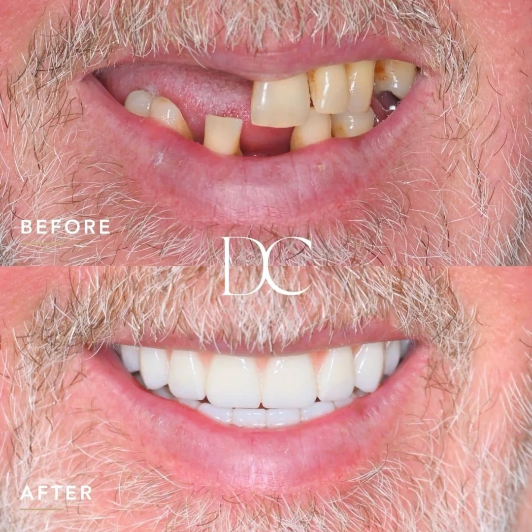 Peter of Melbourne's AO4 Smile Journey in_Dental Couture