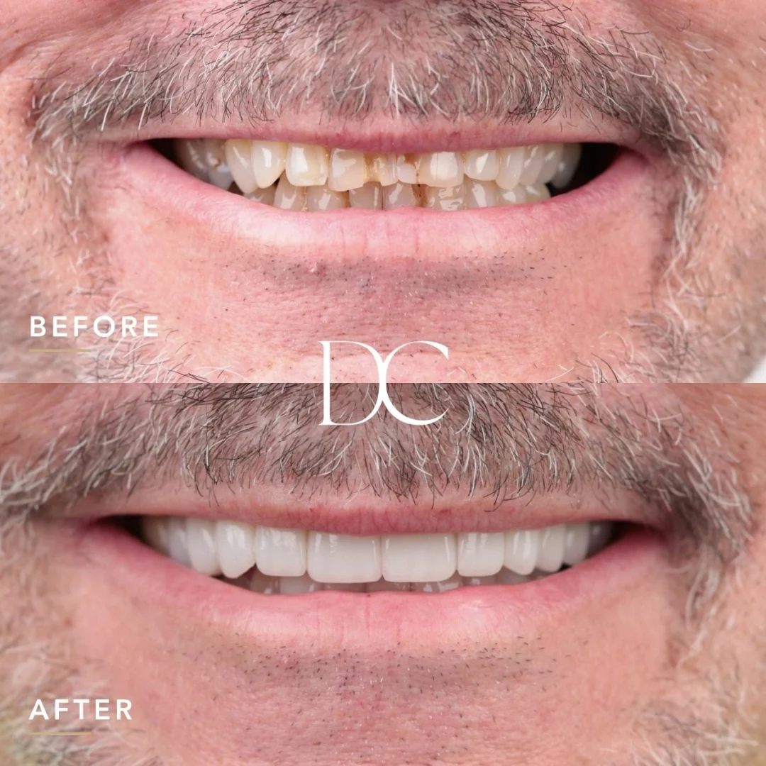 Peter of Melbourne's Porcelain Veneers Journey at Dental Couture