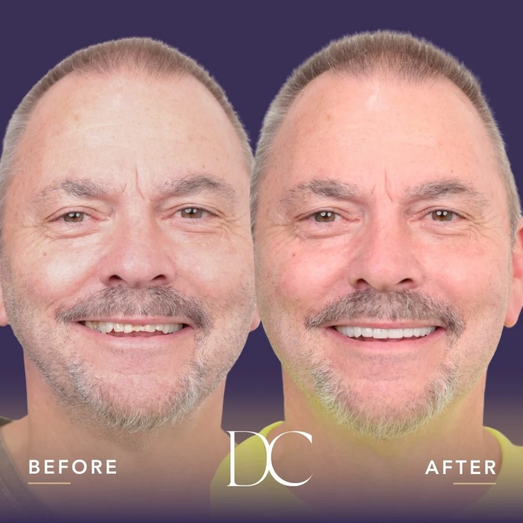 Peter of Melbourne's Porcelain Veneers Journey in Dental Couture
