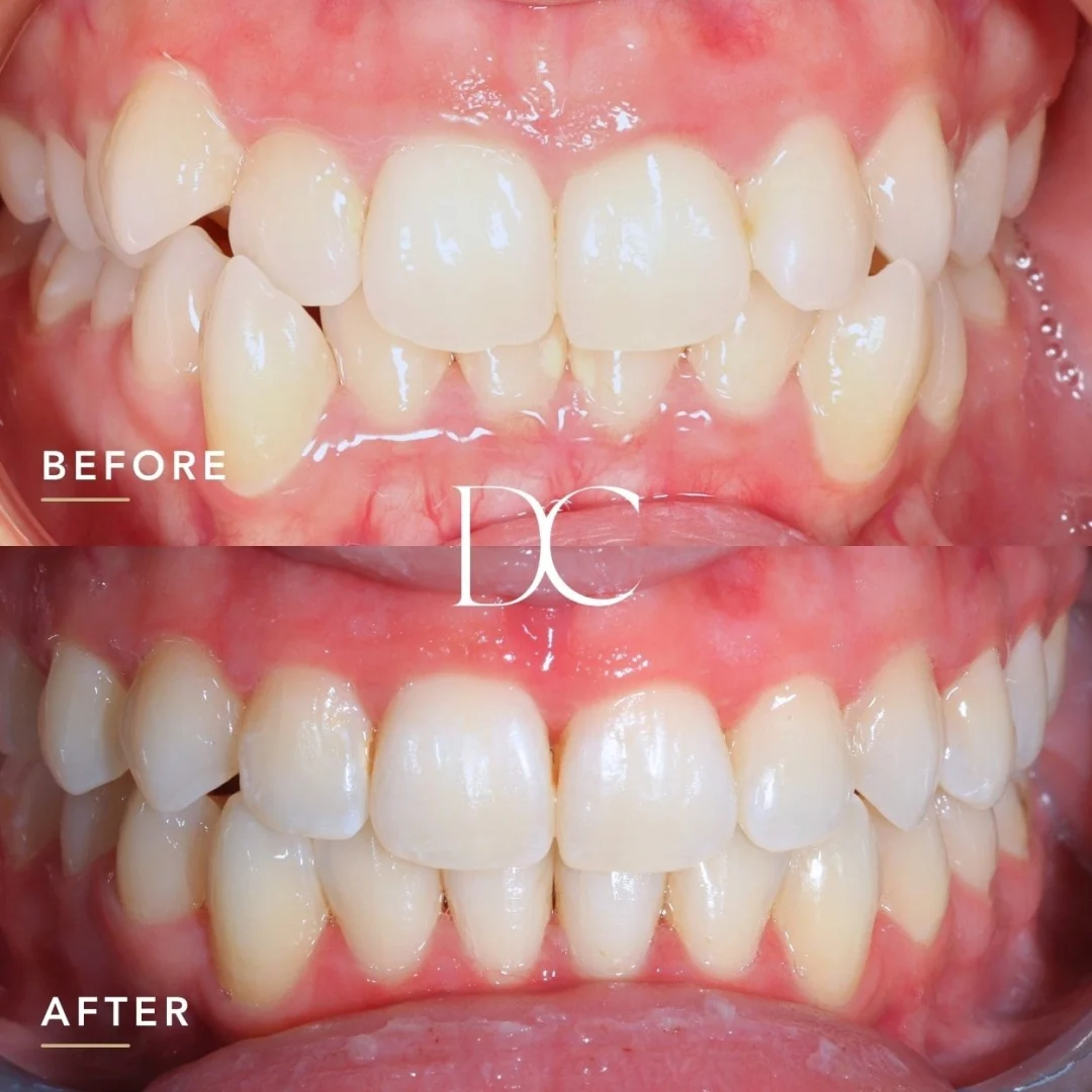 Piper Of Melbourne North West's Invisalign Journey At Dental House