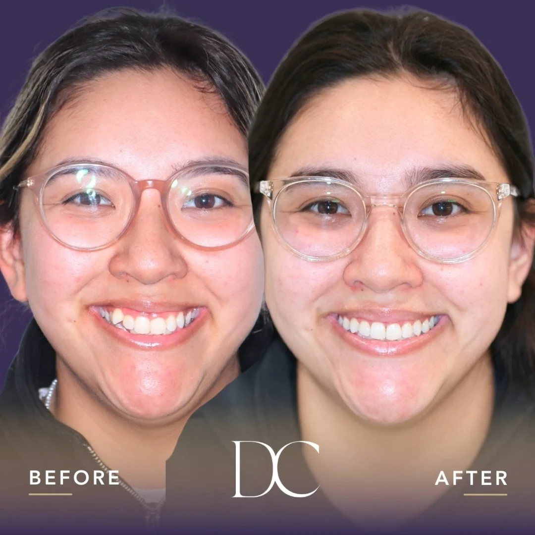 Piper Of Melbourne North West's Invisalign Journey In Dental House