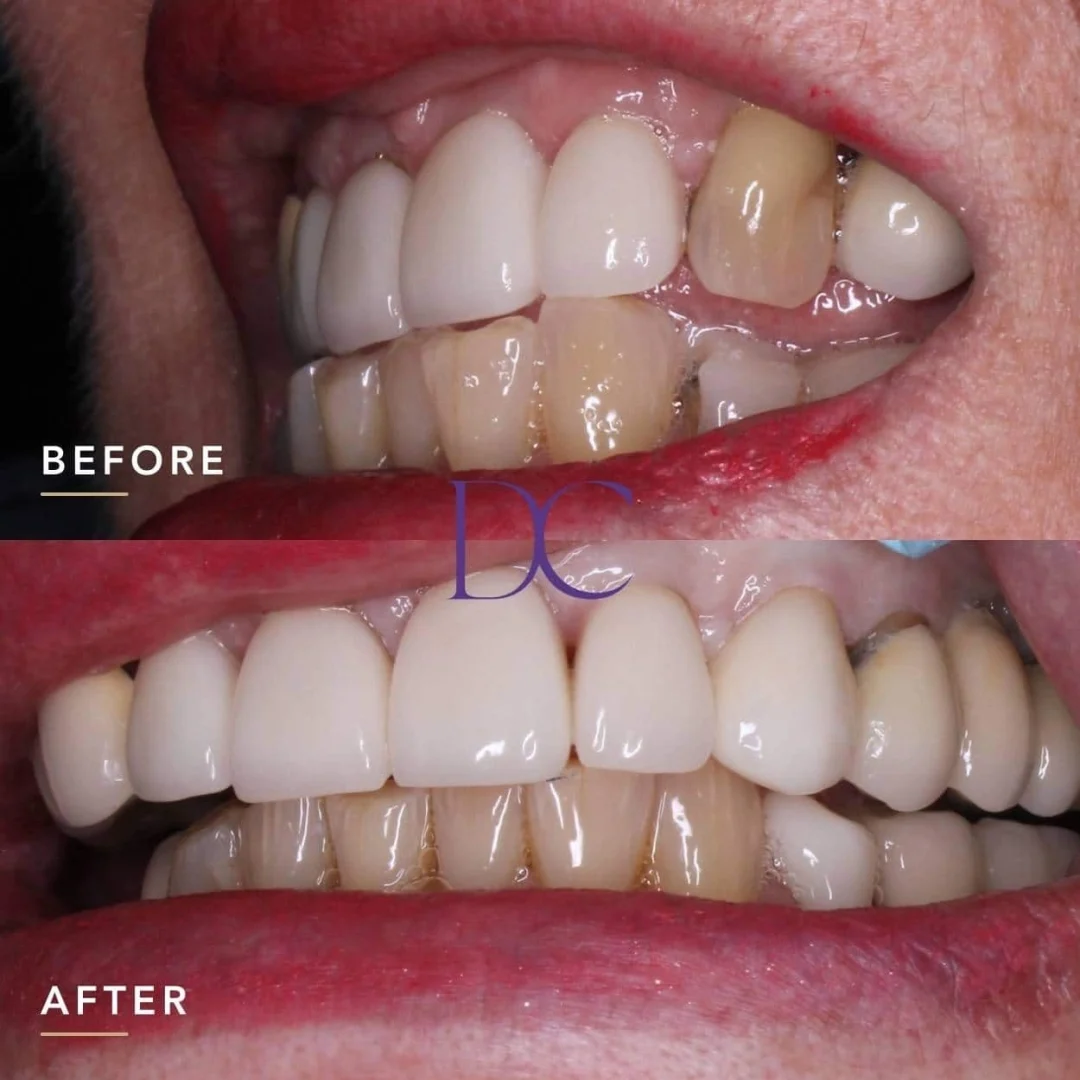 Porcelain Crown Journey in Melbourne North West At Dental Couture