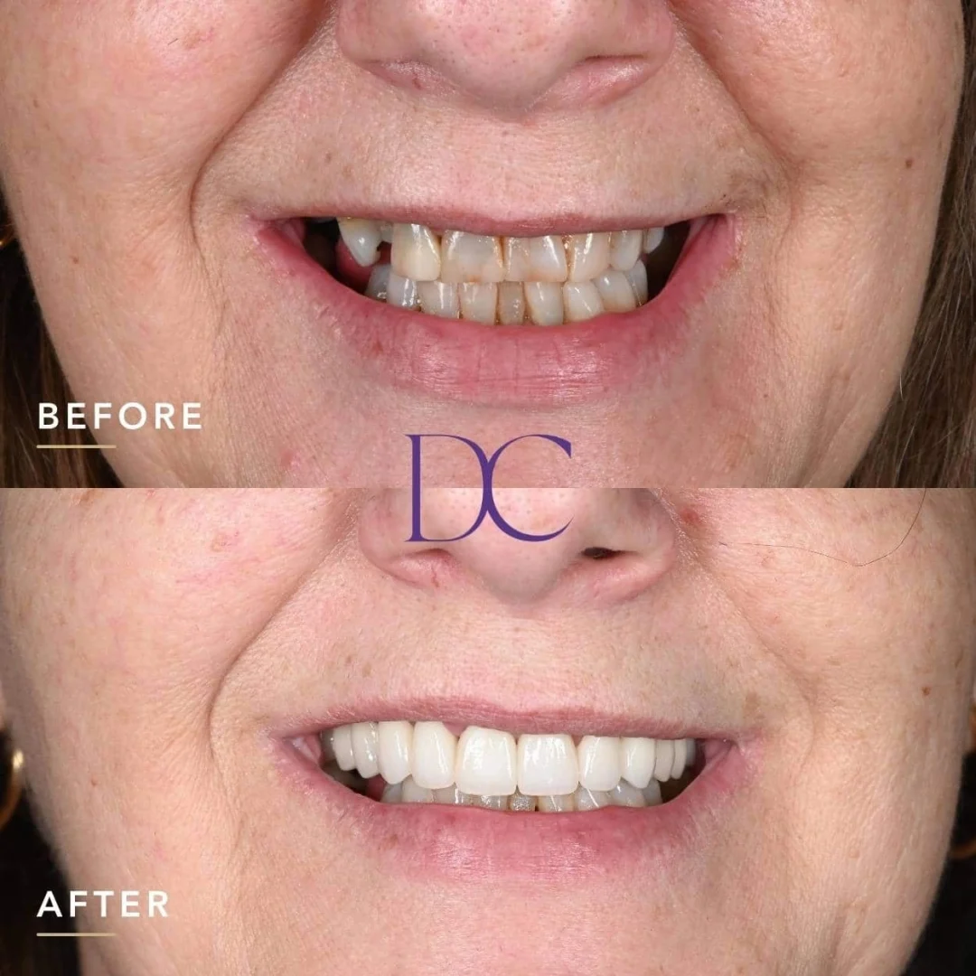 Porcelain Crowns and Bridge Journey in Melbourne North West At Dental Couture