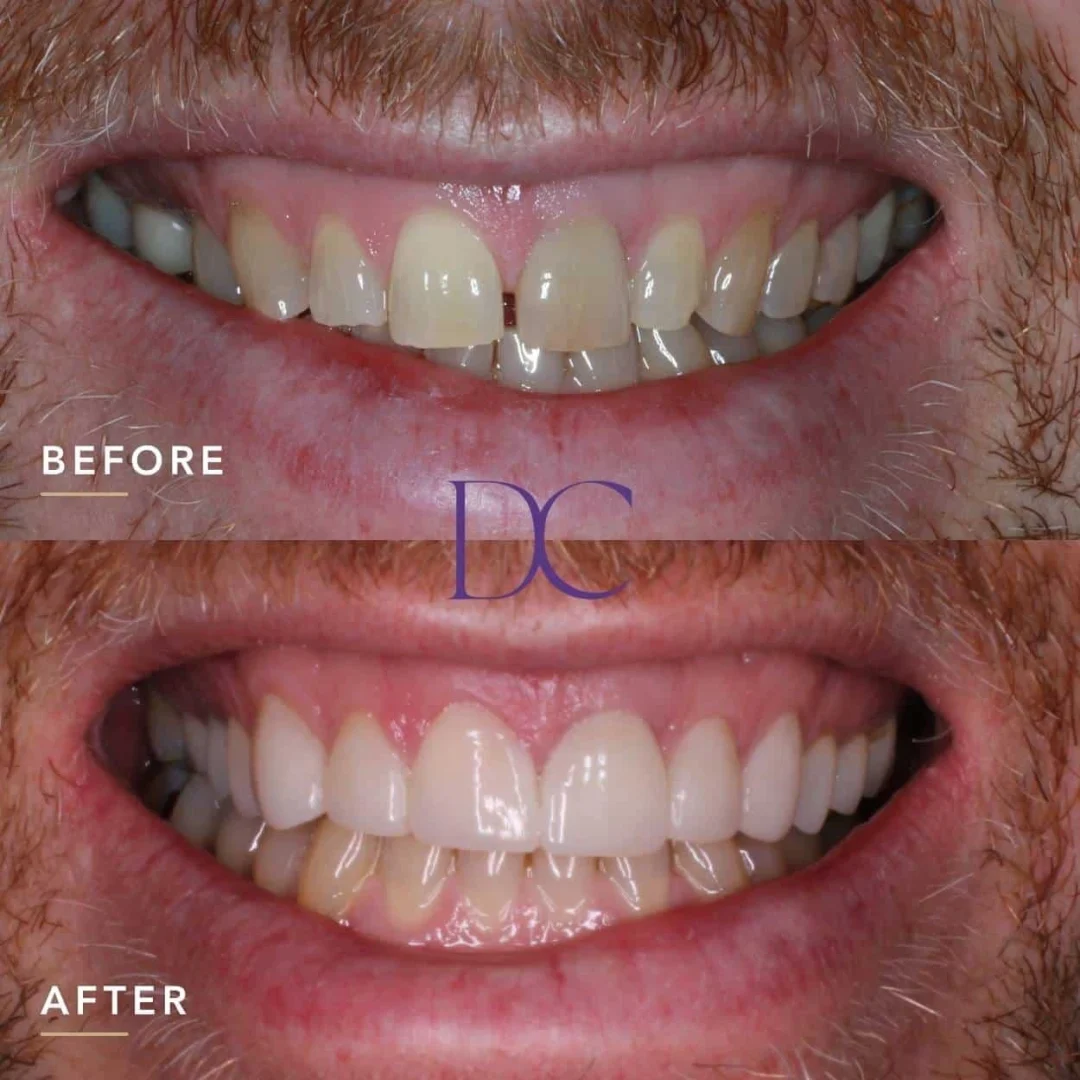 Porcelain Veneers and Crowns Journey in Melbourne North West At Dental Couture