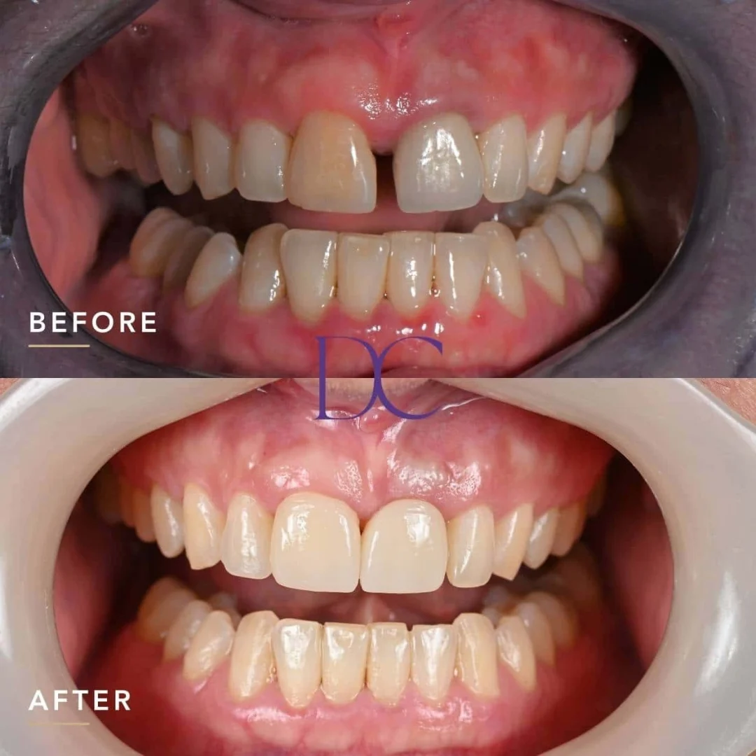 Rachael G's Dental Implants and Invisalign Journey in Melbourne North West At Dental Couture