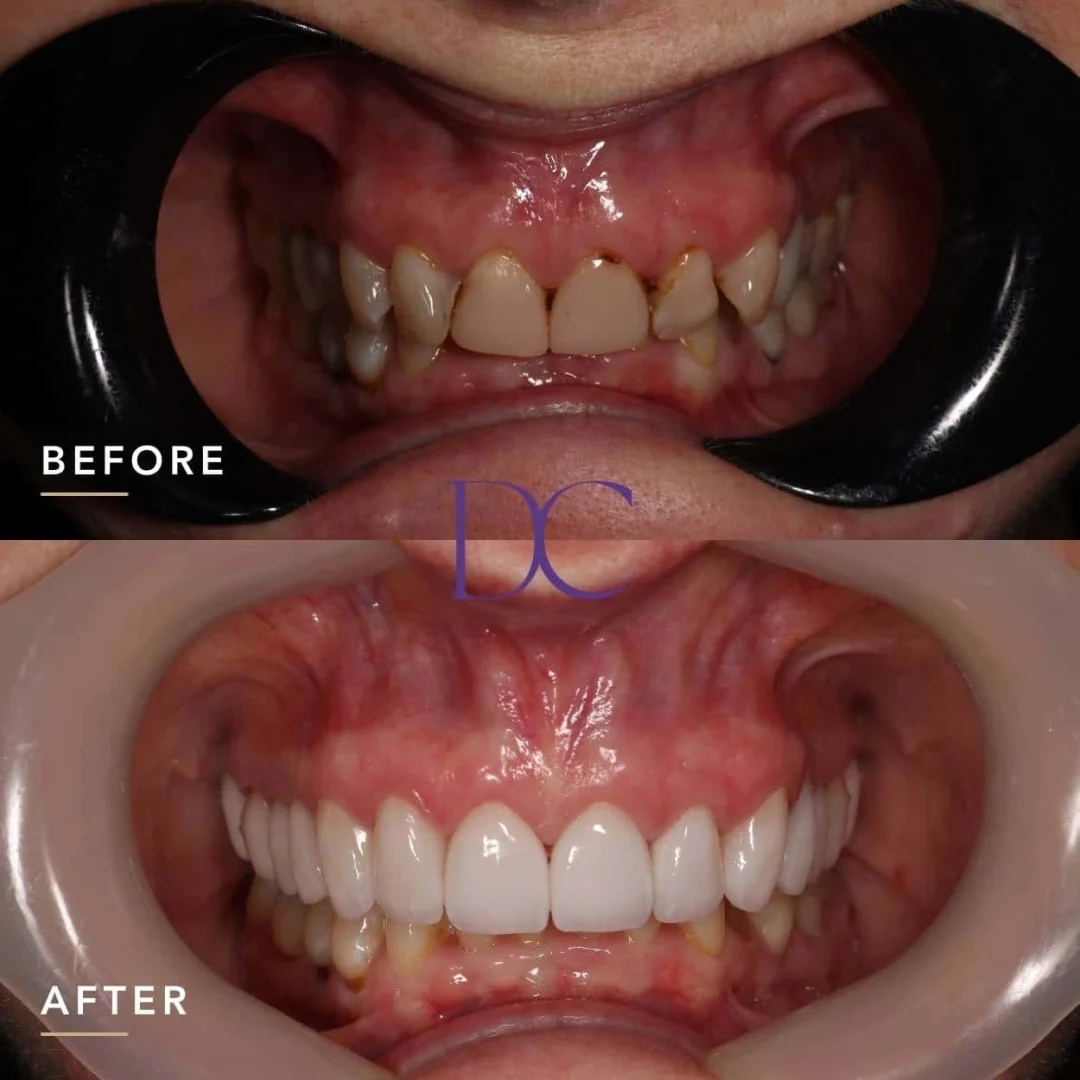 Sally's Dental Veneers and Dental Crowns Journey in Melbourne North West At Dental Couture