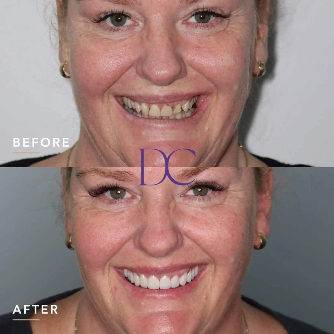 Sally's Porcelain Crowns and Veneers Journey in Melbourne North West At Dental Couture