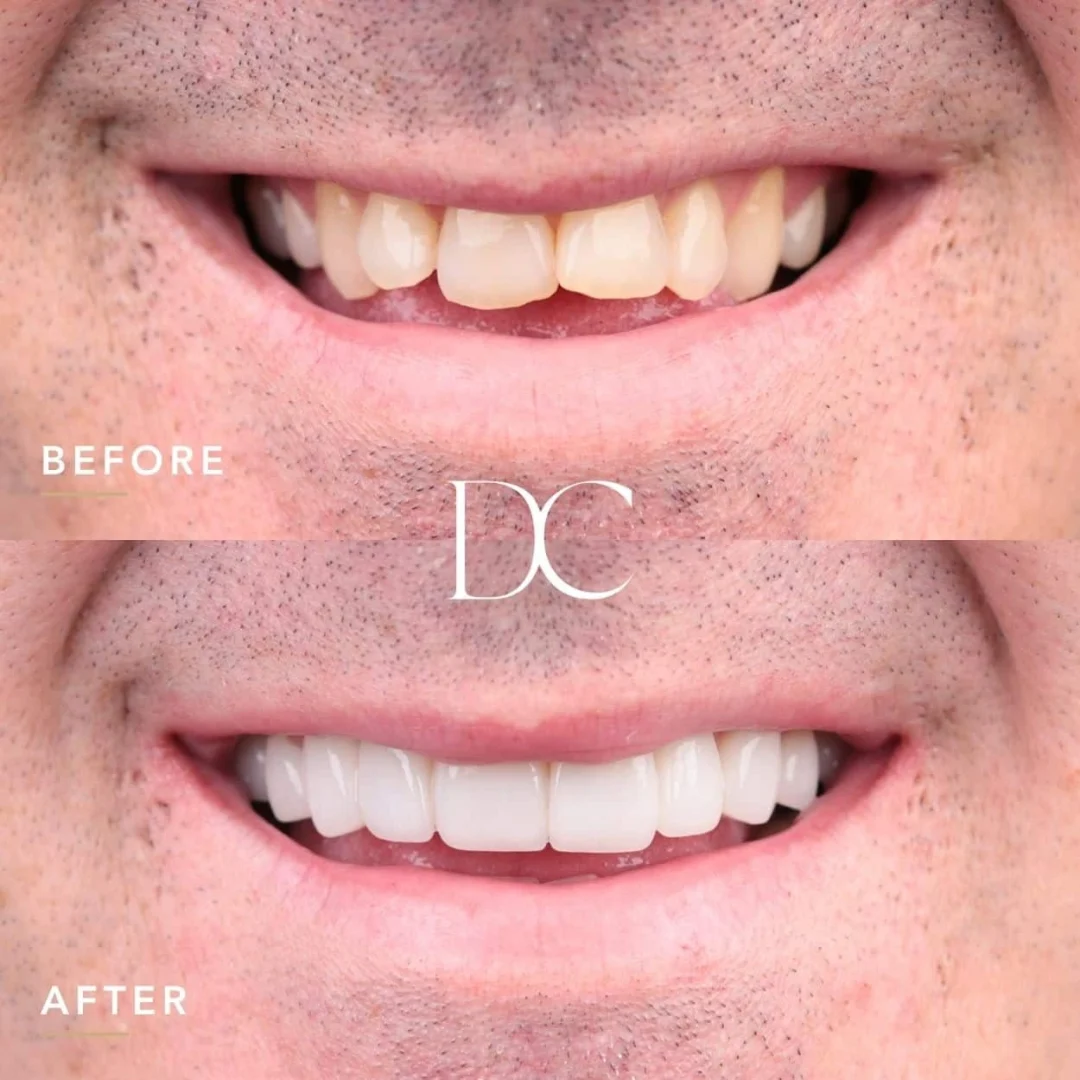 Sam of Sunbury's Veneers Journey In Dental Couture