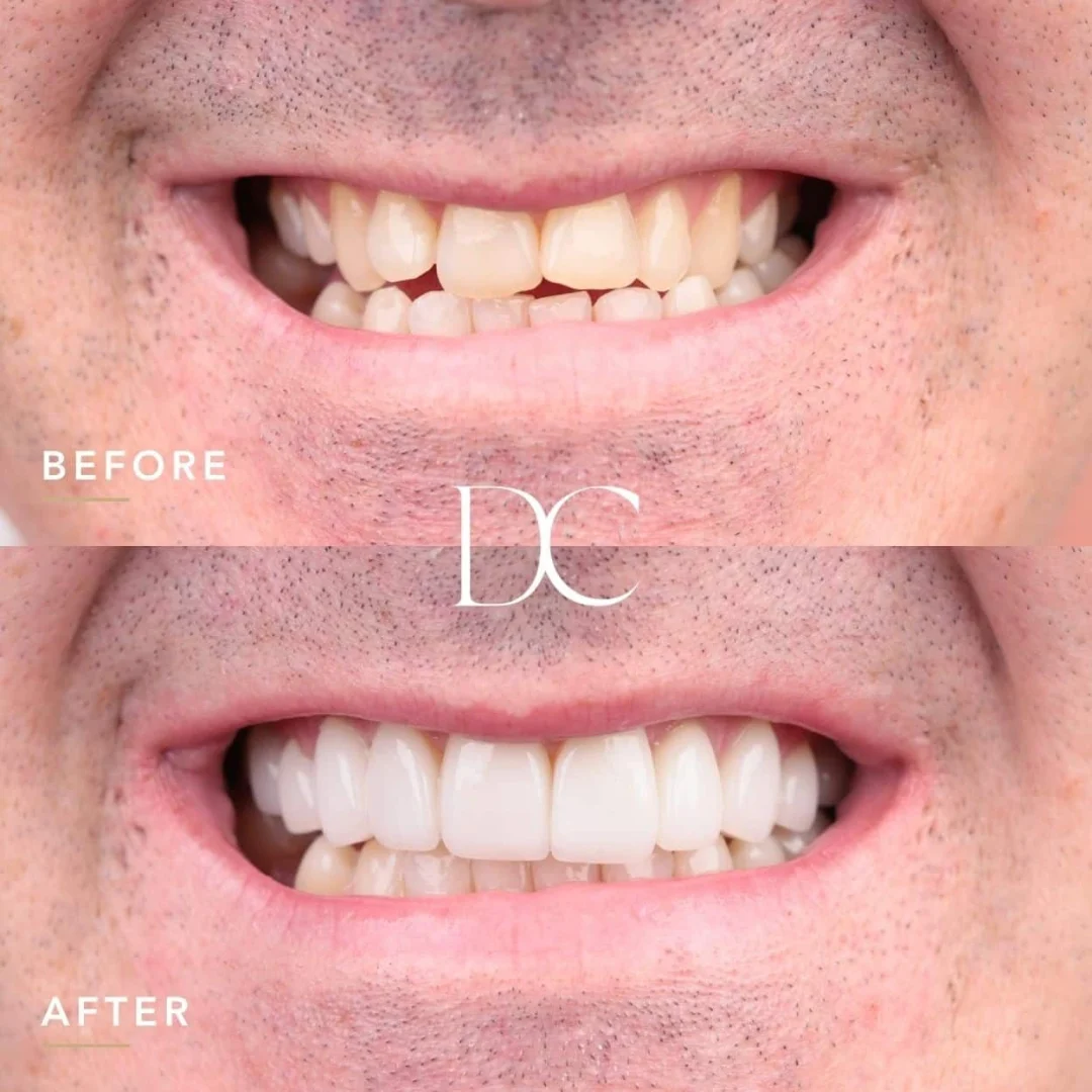 Sam of Sunbury's Veneers Journey In Dental Couture