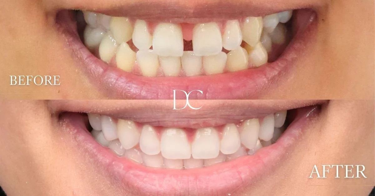 Samanthas Smile Makeover at Dental Couture