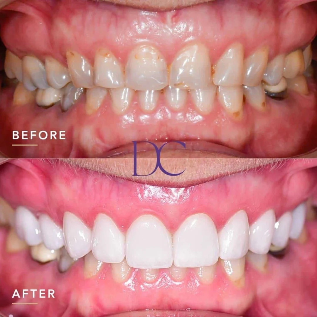 Sarah’s Porcelain Veneers Journey in Melbourne North West At Dental Couture