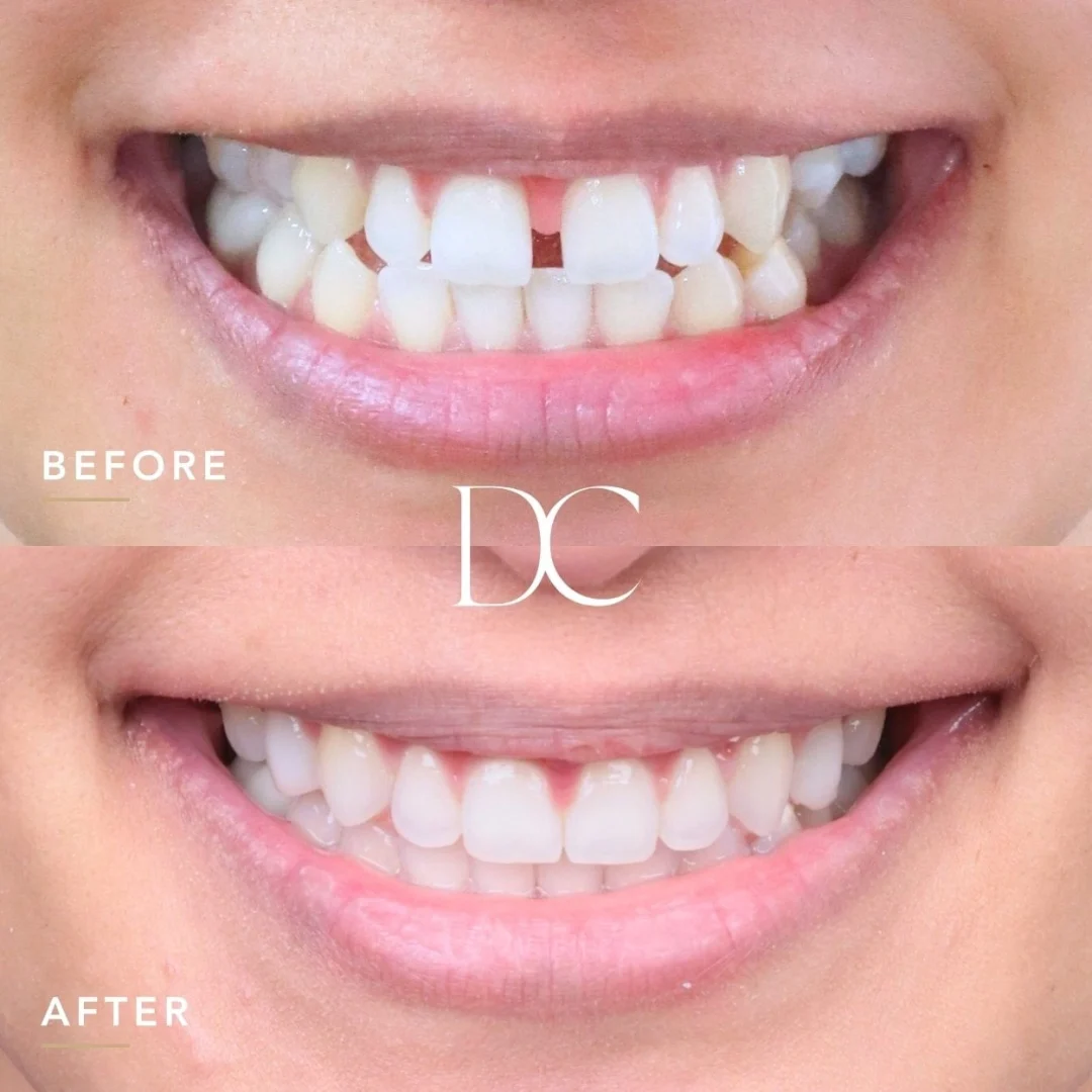 Tess Of Melbourne North West's Invisalign Journey In Dental House