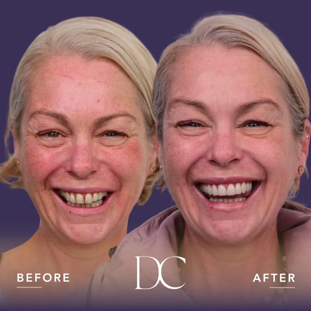 Porcelain Veneers
