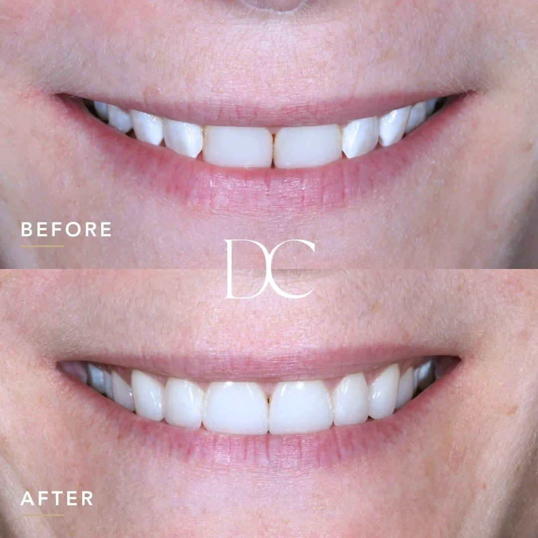 Yve Of Melbourne North West's Veneers Journey At Dental House