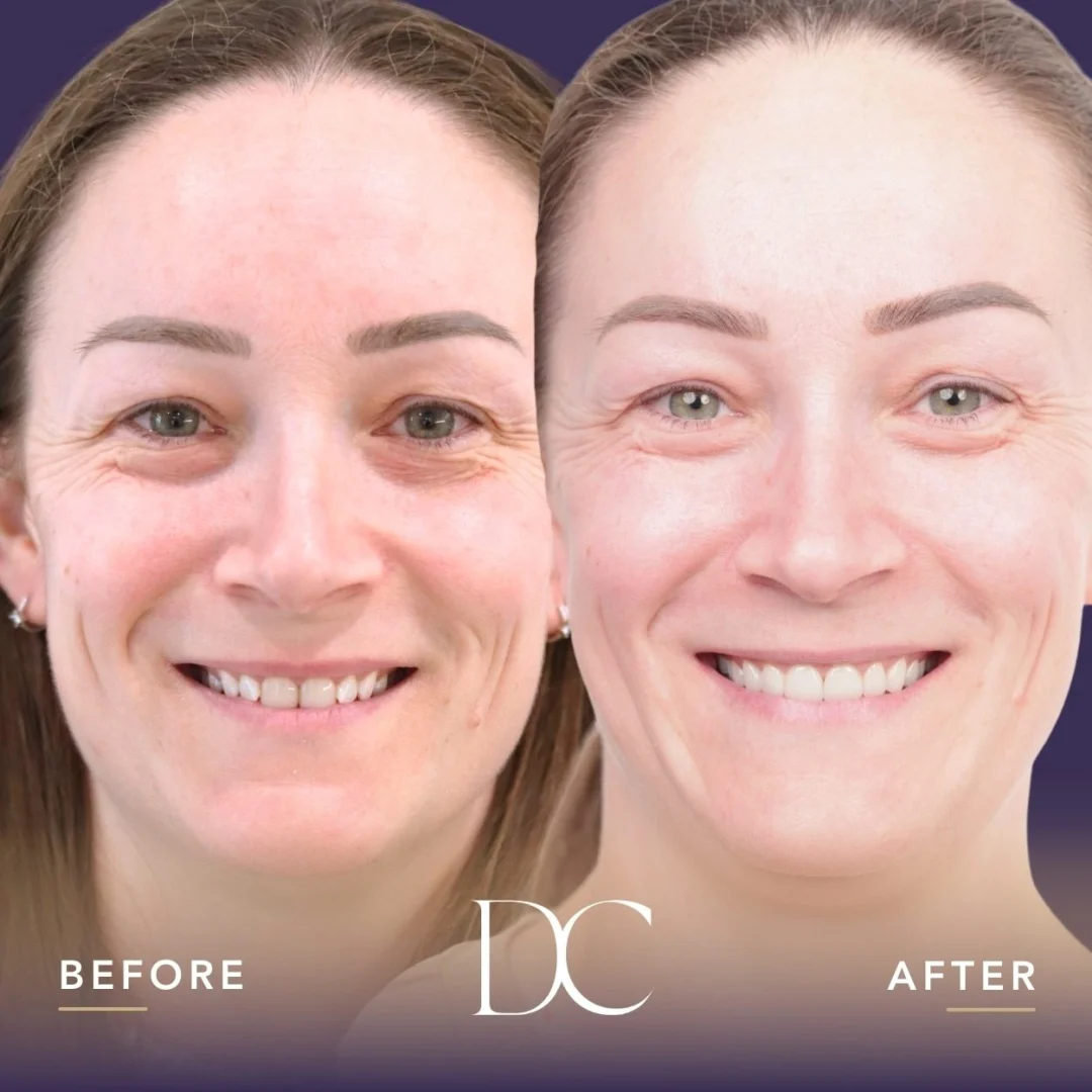 Yve Of Melbourne North West's Veneers Journey In Dental House